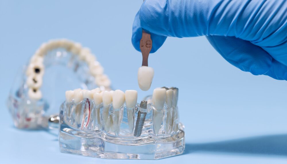 dental implants near sandy